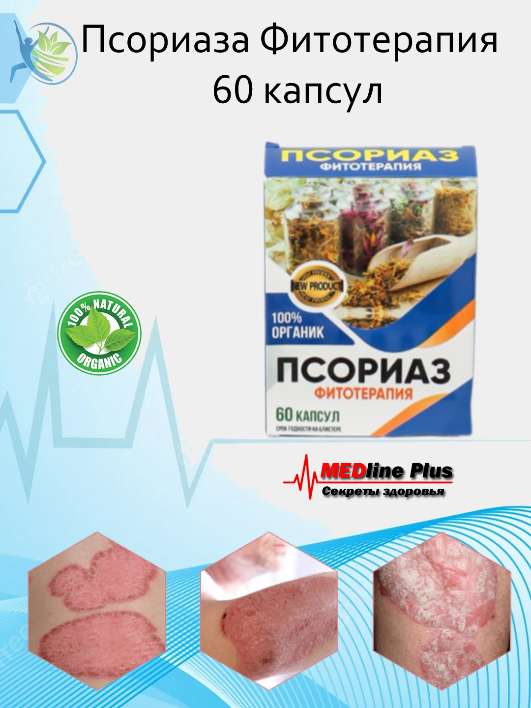 Фитотерапия псориаза Антибактериальное лечение ран при псориазе, 60 ...