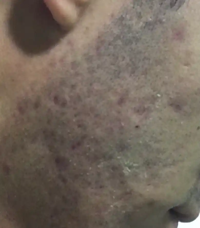 Средство против прыщей Dermion