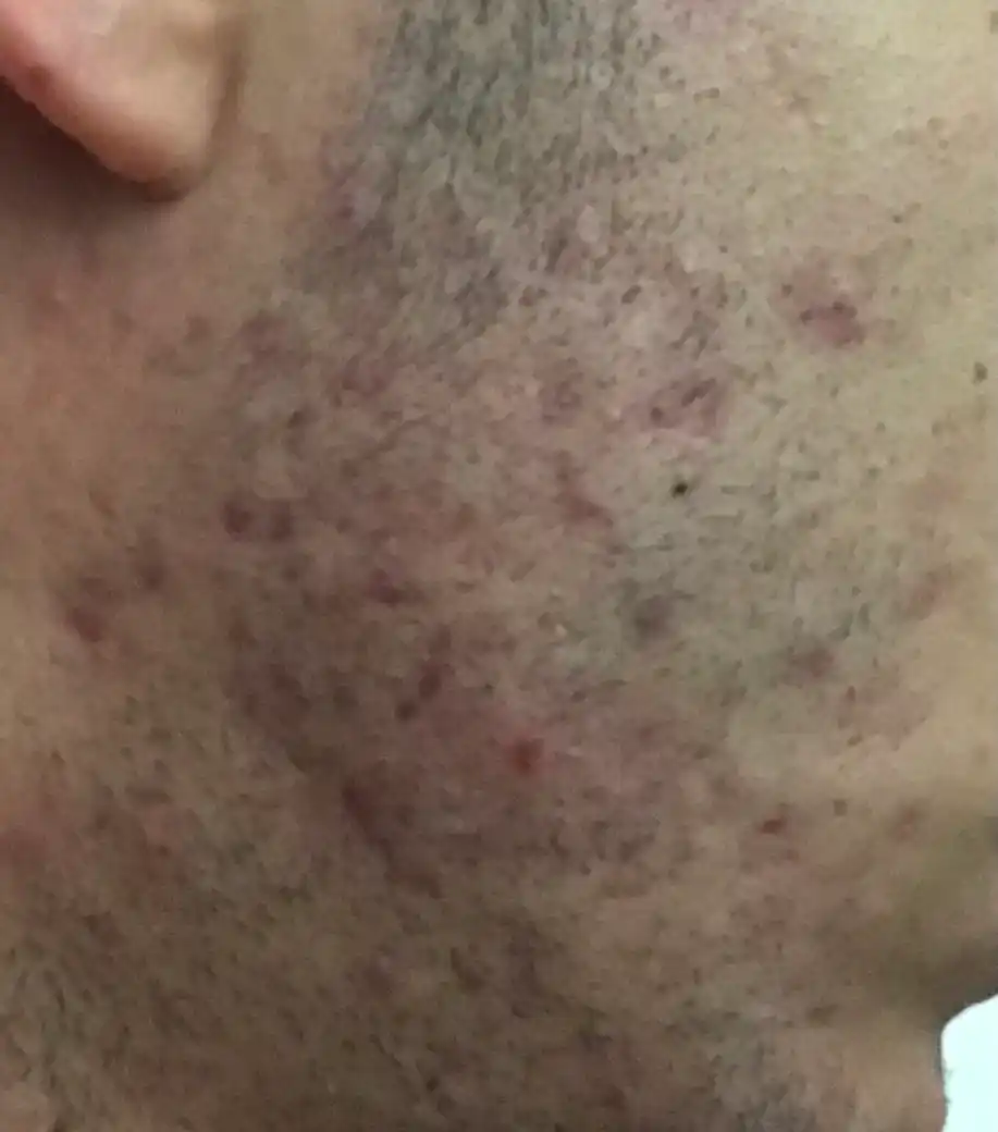 Средство против прыщей Dermion