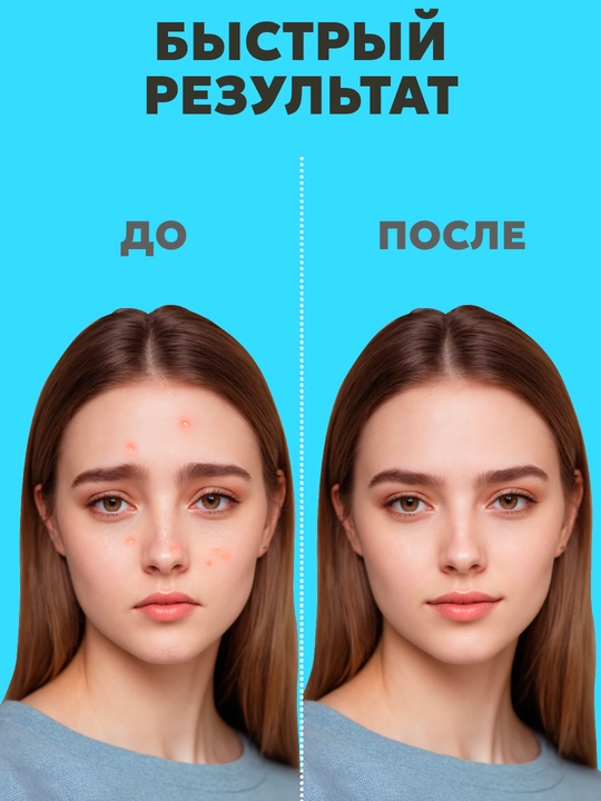 Патчи от прыщей и акне, против воспалений с маслом чайного дерева