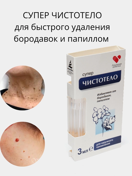 CHISTOTEL papillomalar va so'gallarni olib tashlaydigan kuydirmaydi va chandiq qoldirmaydi - 