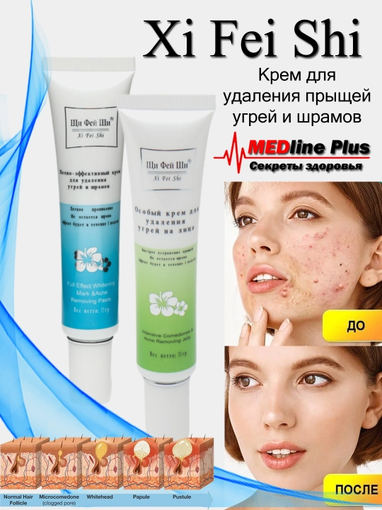 Ugri va akne chandiqlarni olib tashlash uchun krem, Xi Fei Shi, 35 g - 
