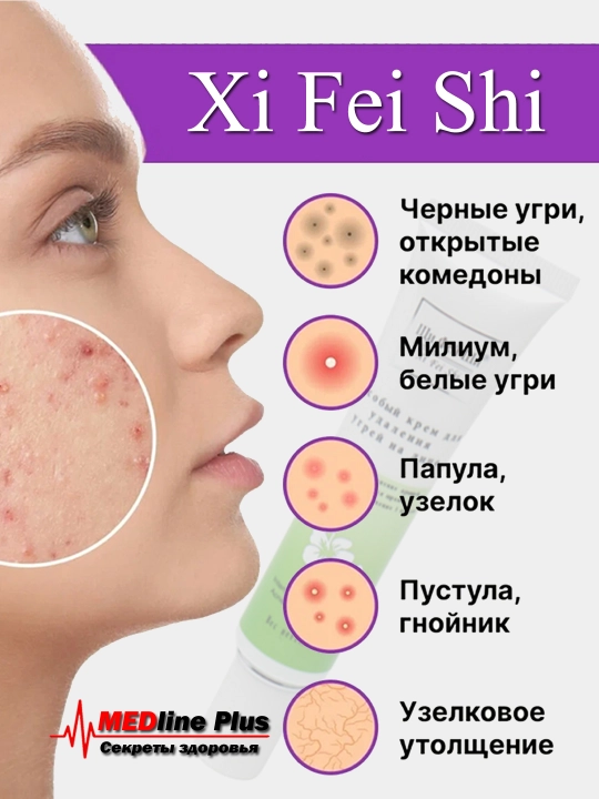 Ugri va akne chandiqlarni olib tashlash uchun krem, Xi Fei Shi, 35 g