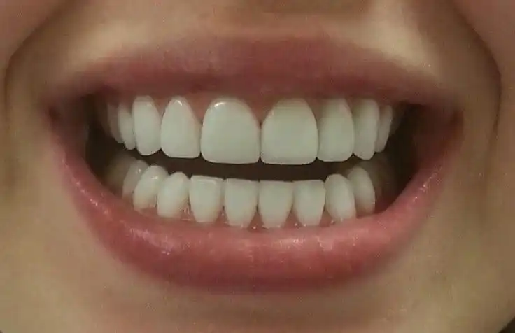 Отбеливающие полоски для зубов, 9D WHITE, полоски для отбеливания