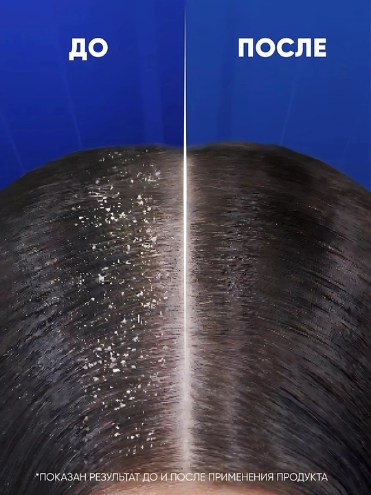 Шампунь Head&Shoulders Pro Expert 7, против перхоти, для жирной кожи головы, 300 мл