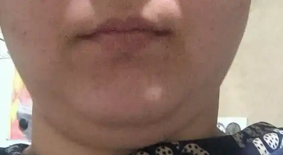 Yuz uchun tuzatuvchi bandaj, iyagi uchun ko'taruvchi niqob