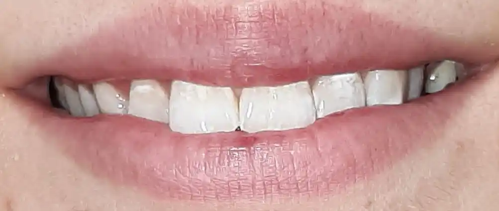 Отбеливающие полоски для зубов, 9D WHITE, полоски для отбеливания