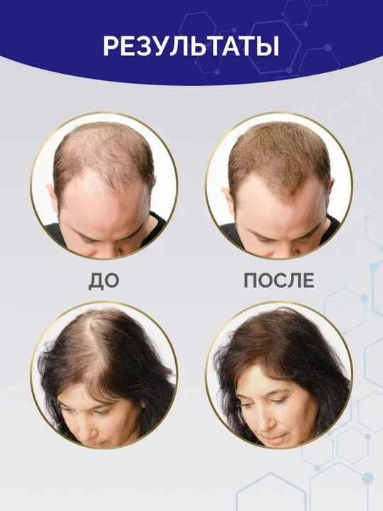 Minoxidin 5% – средство для роста волос и бороды, 60 мл + ПИПЕТКА и ДЕРМАРОЛЛЕР В ПОДАРОК