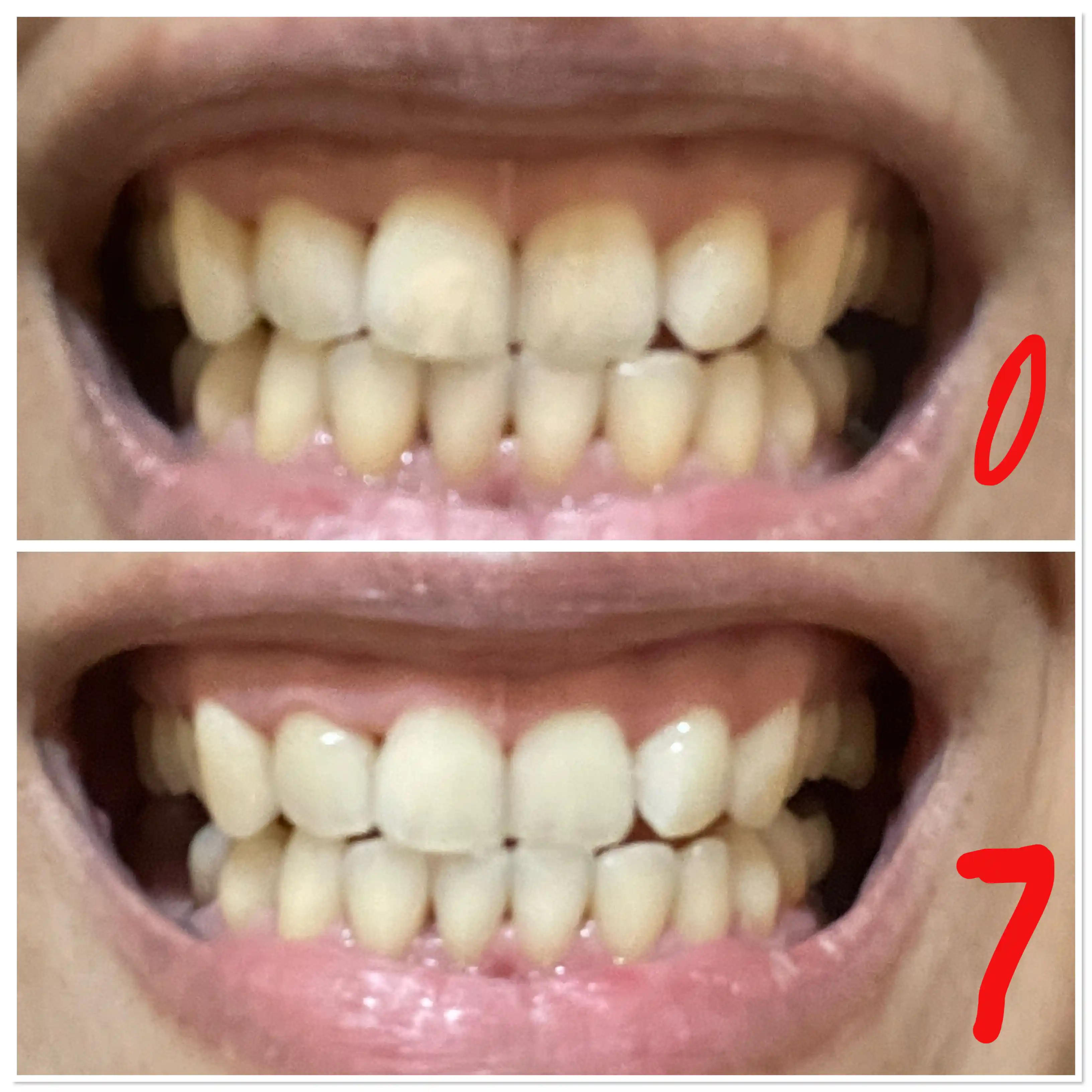 Отбеливающие полоски для зубов 5D White, 7 шт