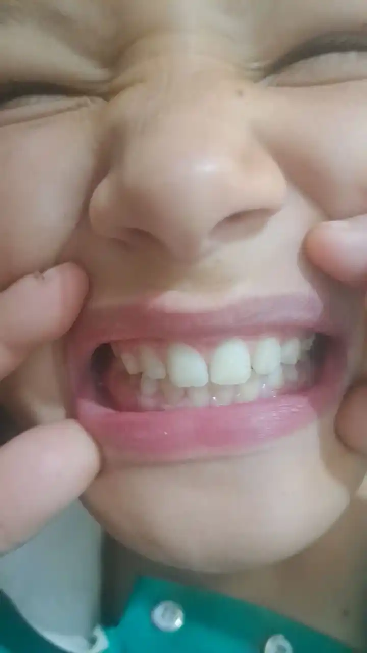 Oqartiruvchi tish qirg'ichlari
