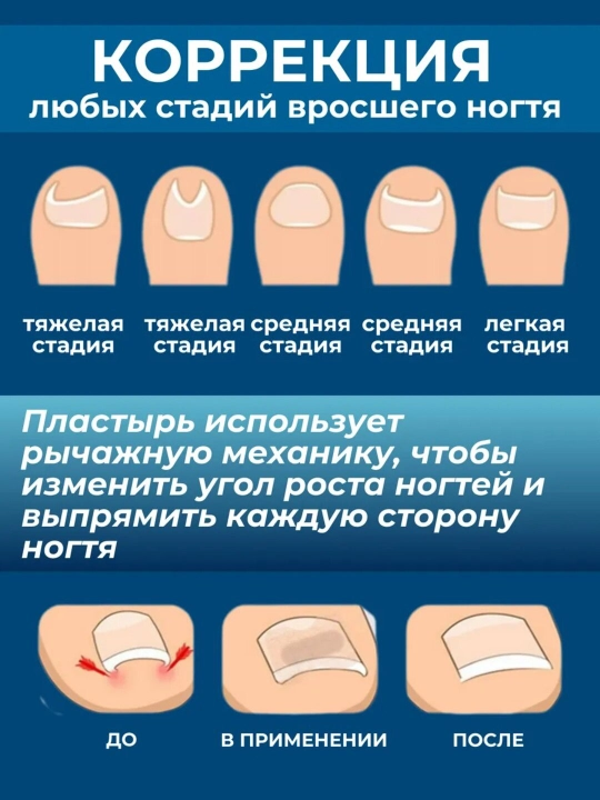 Корректор от вросших ногтей с защитными наклейками для педикюра