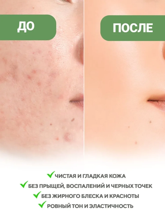 Anua, Azelain kislotali zardob Anua Azelaic Acid 10 Hyaluron Redness Soothing Serum, 30 ml