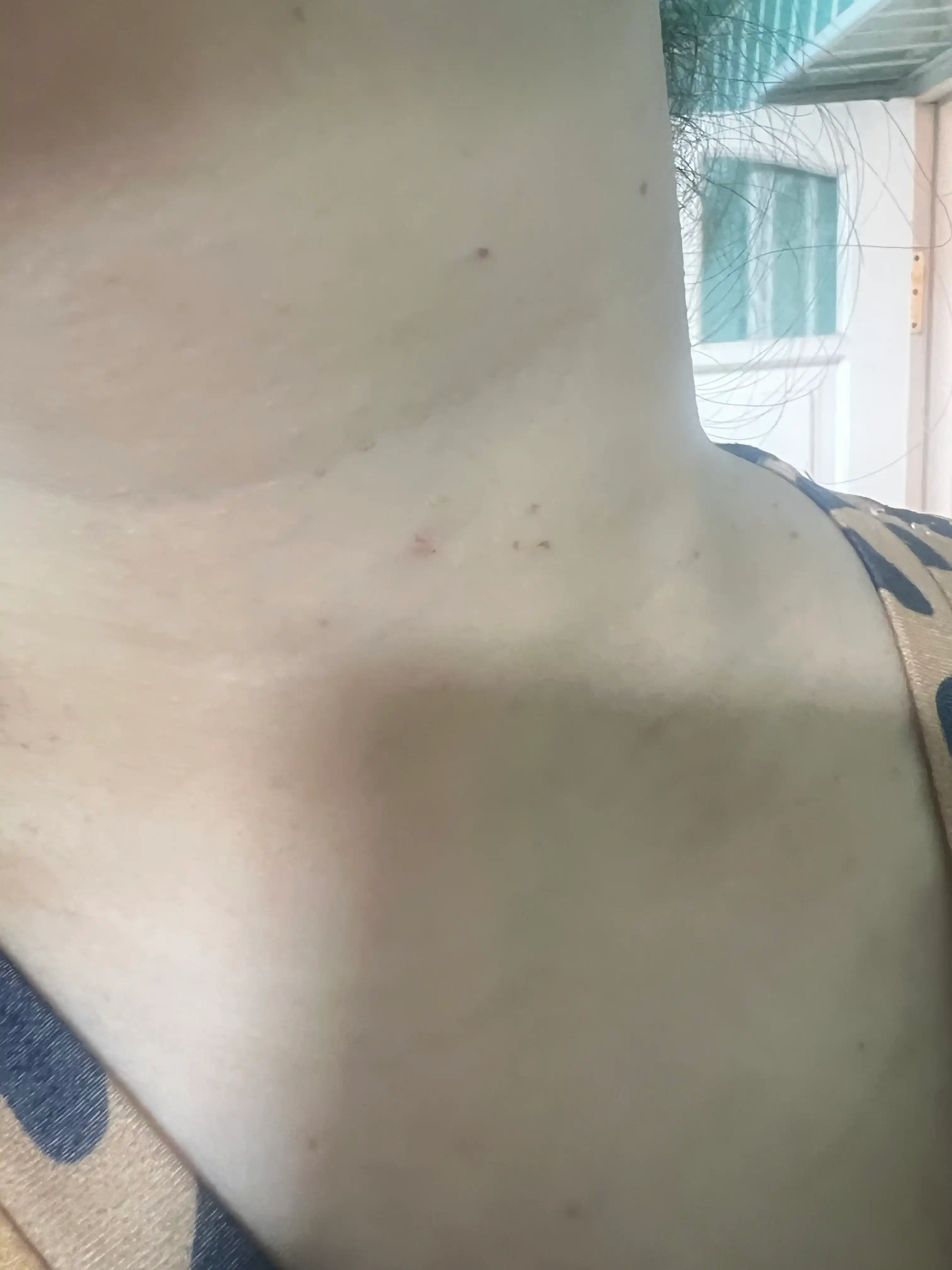 Sig'il va papillomalar uchun kosmetik vosita, lazer ruchka, koagulyator