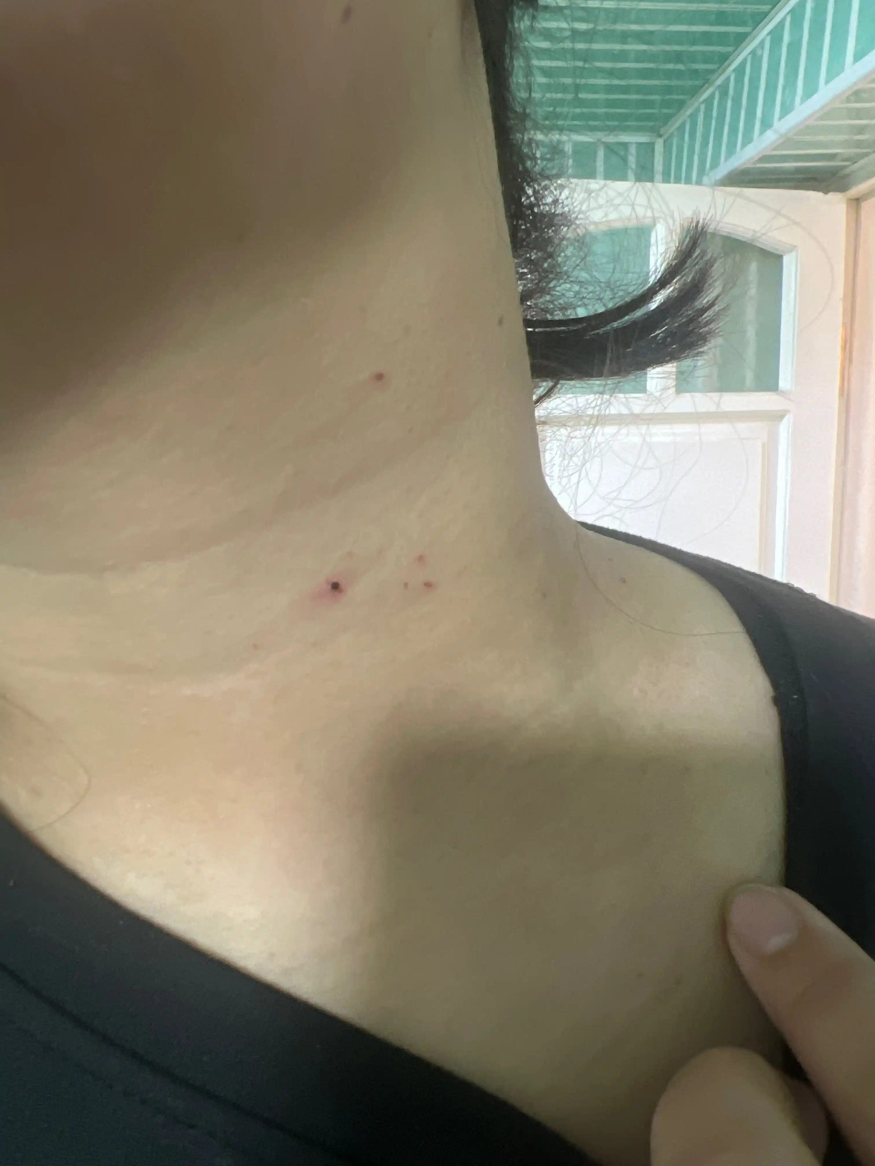 Sig'il va papillomalar uchun kosmetik vosita, lazer ruchka, koagulyator