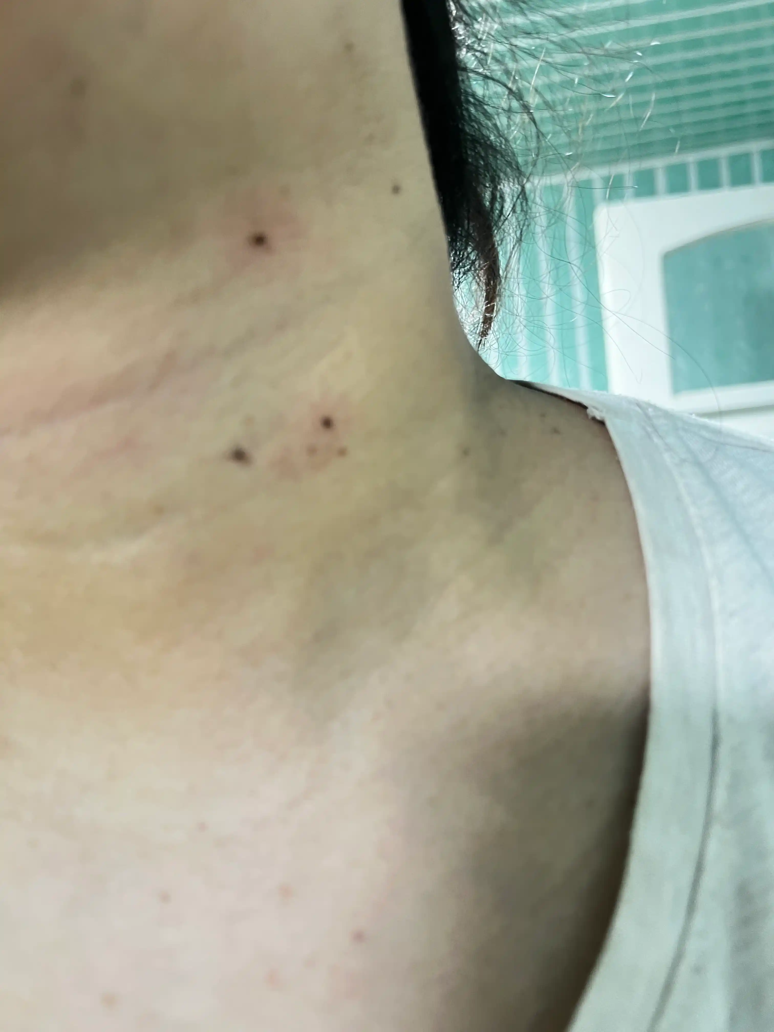 Sig'il va papillomalar uchun kosmetik vosita, lazer ruchka, koagulyator