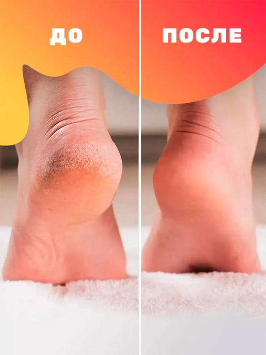 Размягчающий бальзам для ног FootCare, от сухих мозолей и натоптышей, 150 мл, Ф-455