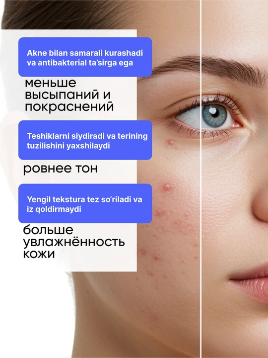 ZODIAC yuz uchun zardob, serum, gialuron kislota, namlaydi, niatsinamid, akne uchun, 30 ml