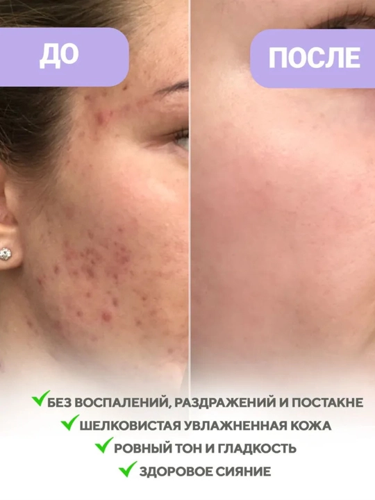 Успокаивающий крем для лица с ресвератролом, от покраснений и раздражений, от акне 50 мл