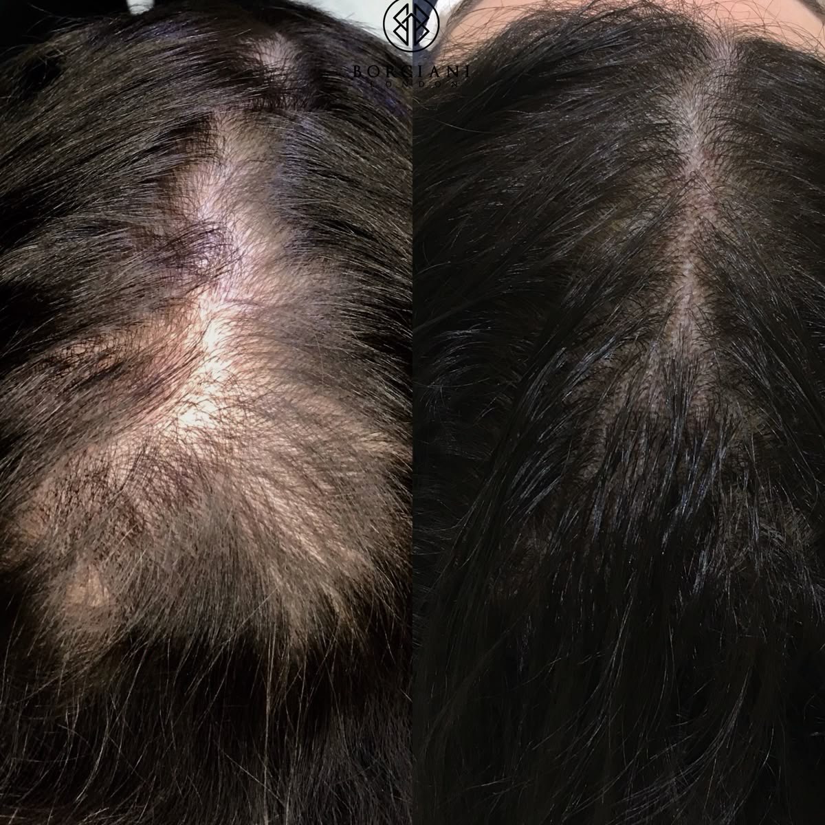 Keratin niqobi sochlarning o‘sishi va uzunligini oshiradi soch to‘kilishiga qarshi
