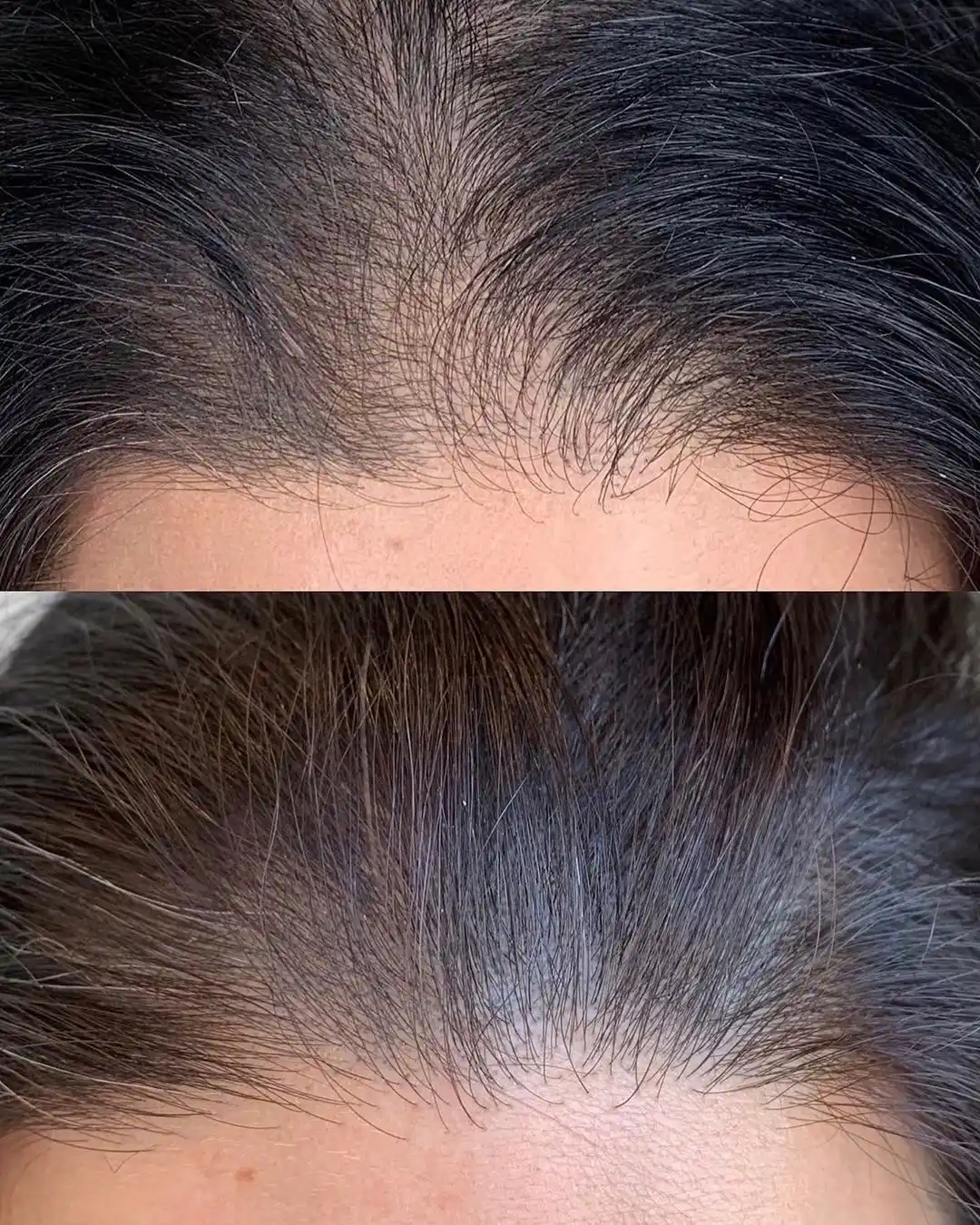 Keratin niqobi sochlarning o‘sishi va uzunligini oshiradi soch to‘kilishiga qarshi