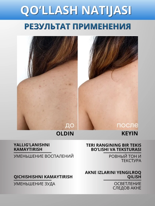 ICON SKIN Tana terisi uchun zardob-sprey, anti-akne, muammoli tana terisi uchun, 100 ml
