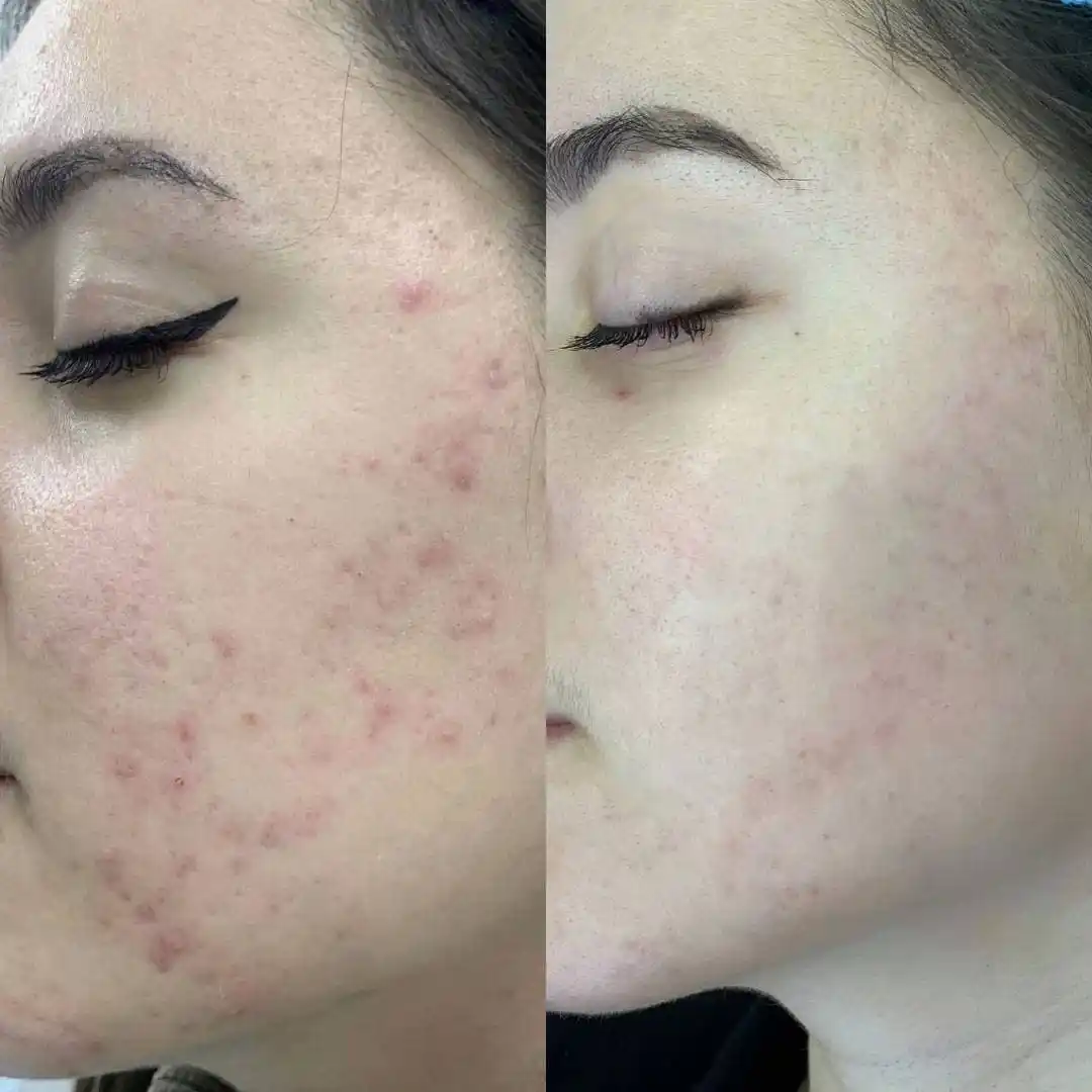 COSRX Salicylic Acid Пенка с салициловой кислотой для проблемной кожи