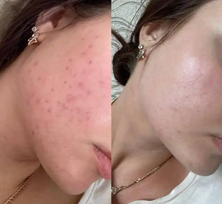 Кровавый пилинг для лица кислотный AHA BHA от прыщей, постакне и рубцов