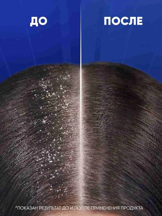 HEAD & SHOULDERS Шампунь против перхоти 7в1, 300 мл