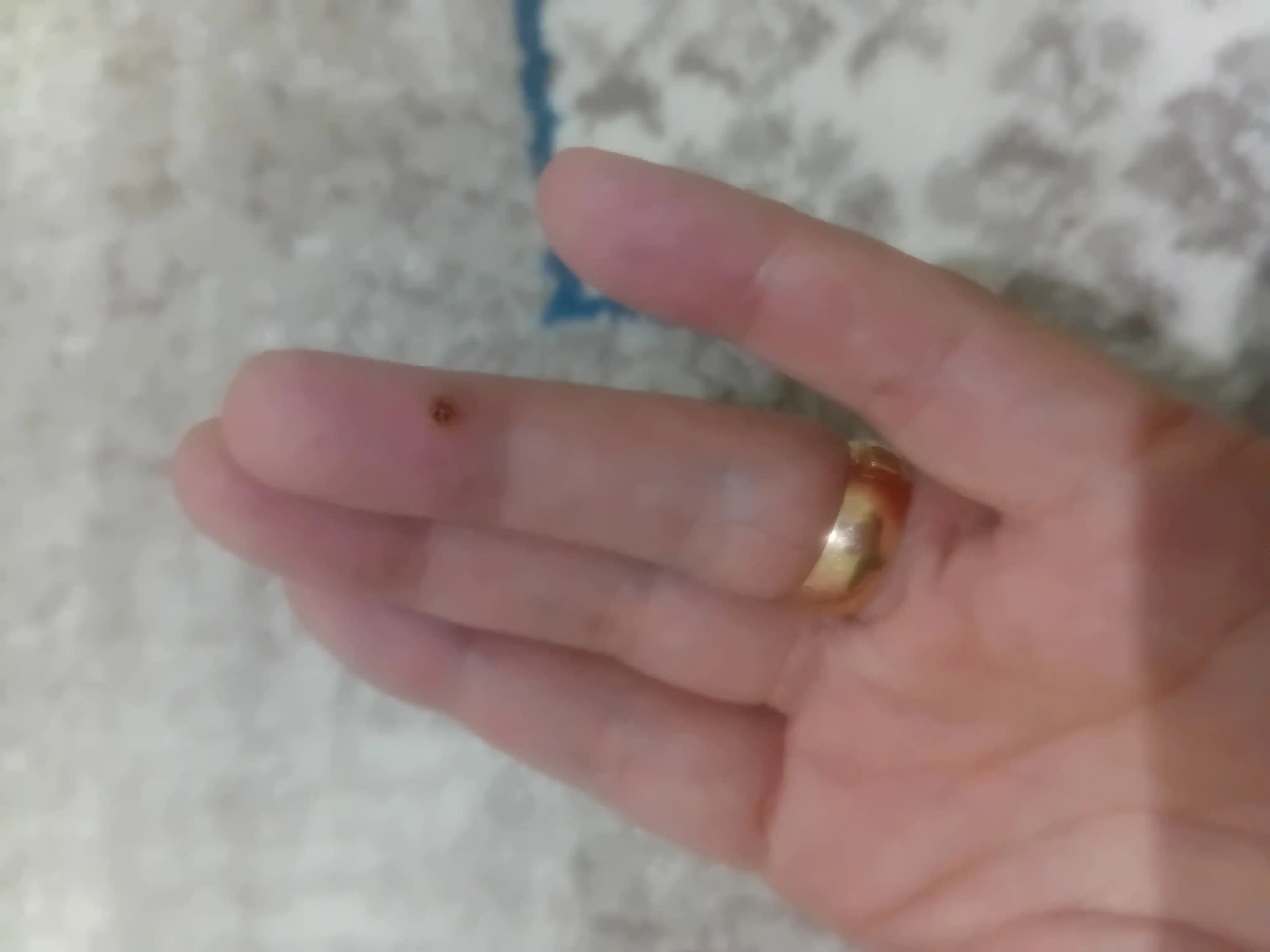 Sig'il va papillomalar uchun kosmetik vosita, lazer ruchka, koagulyator