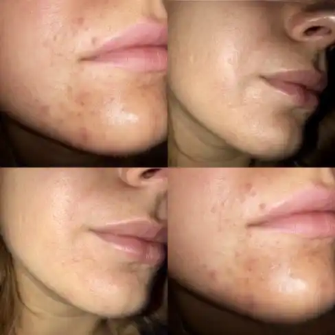 Лечебное мыло Manting для лица и тела Demodex, жирная и комбинированный кожа, против зуда