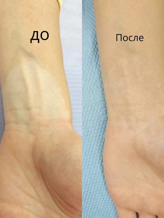 Vitiligo flomaster teridagi oq dog‘larni yopish uchun