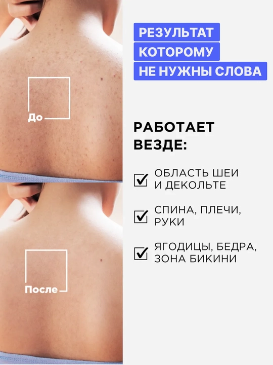 ZODIAC yuz uchun zardob, serum, gialuron kislota, namlaydi, niatsinamid, akne uchun, 30 ml