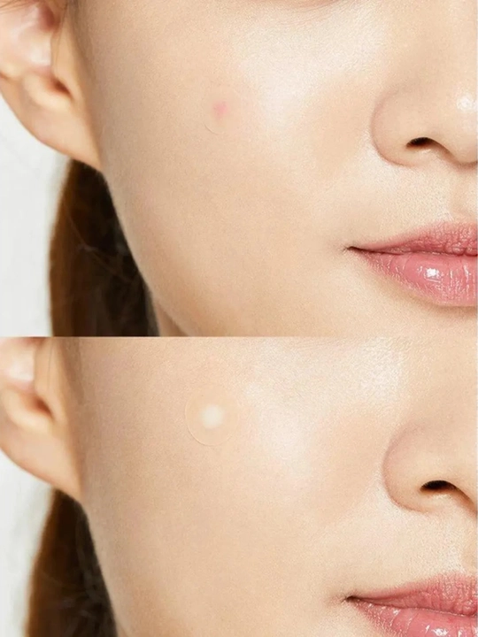 Патчи от прыщей гидроколлоидные COSRX Acne Pimple Master Patch, 24 шт