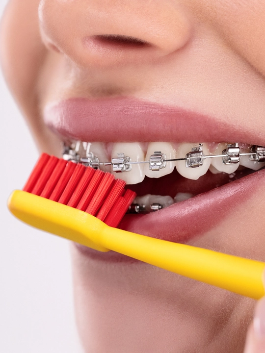 Revyline SM6000 Ortho tish cho‘tkasi breketlar uchun ortodontik yumshoq
