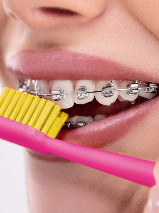 Revyline SM6000 Ortho ortodontik tish cho‘tkasi breketlar uchun yumshoq