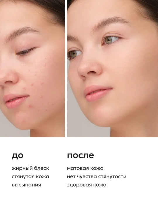 Likato Гель для умывания от прыщей, акне, постакне с AHA кислотами, 250мл