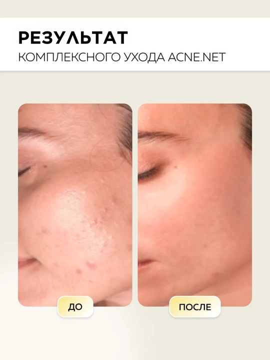 MI&KO экстра-пилинг с кислотами, для проблемной кожи, от пигментации, осветляющий, 15-50мл