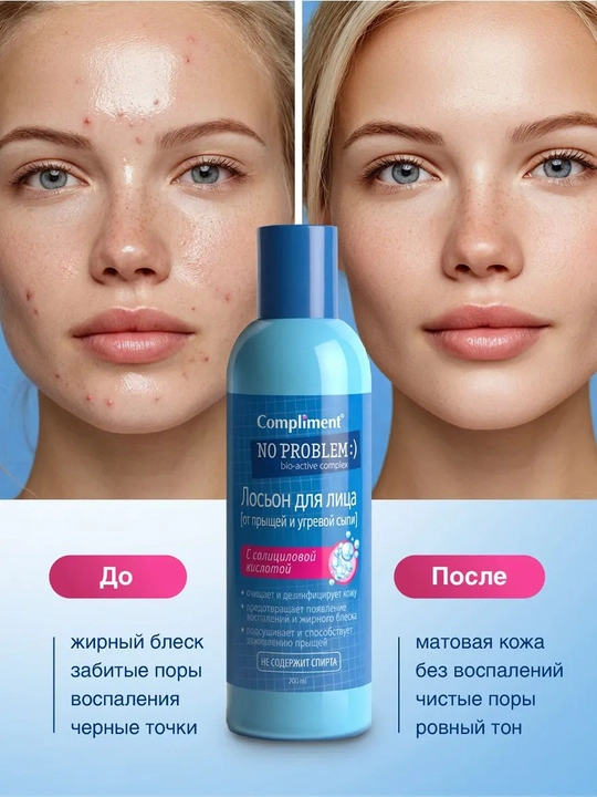 COMPLIMENT Лосьон от прыщей, угревой сыпи NoProb 200 мл
