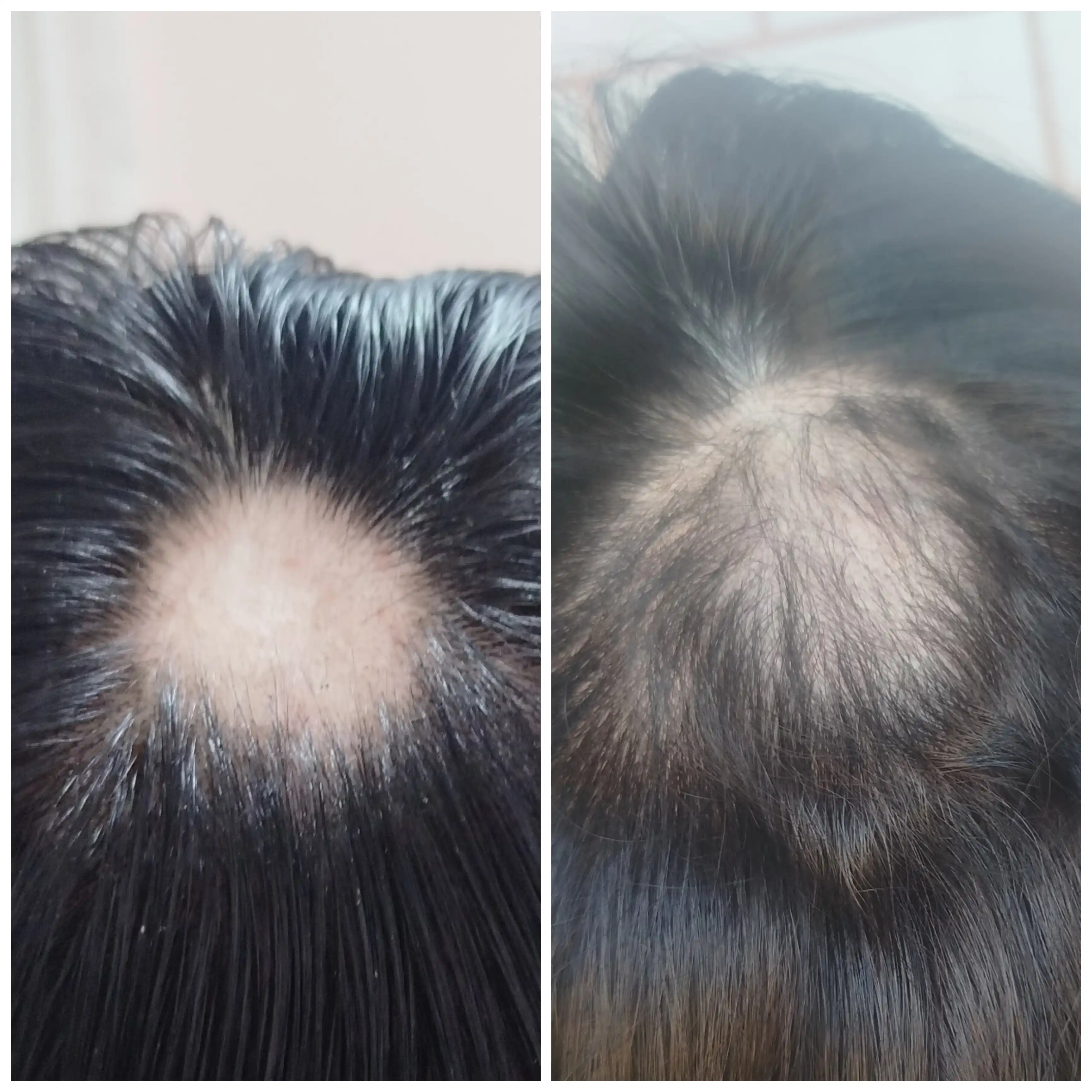 Soch va soqol o'stirish uchun minoksidil Kirkland Minoxidil 5%, 60 ml