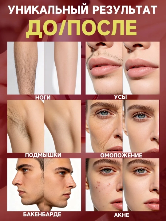Fotoepilyator, lazerli, professional, sochni olib tashlash uchun