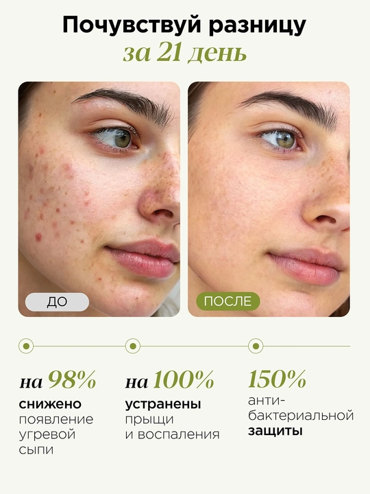 MIXIT Stop Acne гель-патч с кислотами, для проблемной кожи, 15 мл