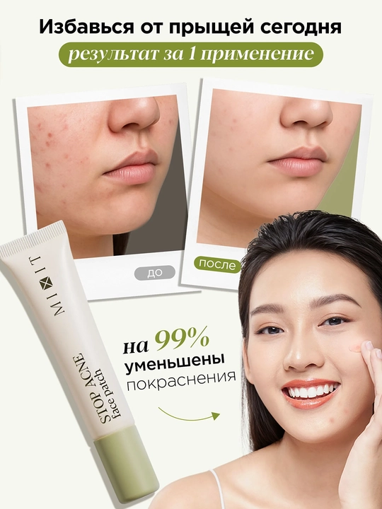 MIXIT Stop Acne гель-патч с кислотами, для проблемной кожи, 15 мл