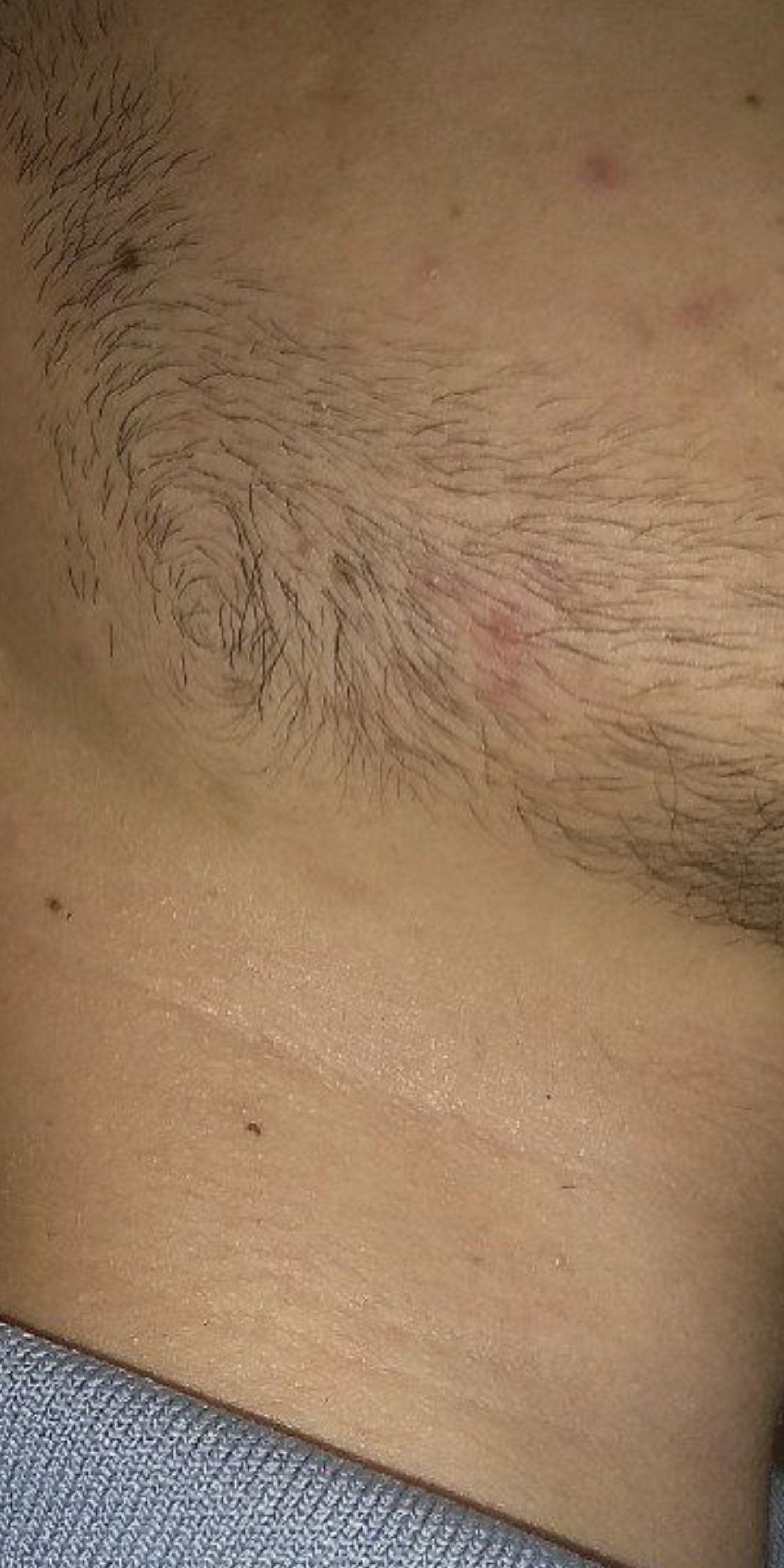 Minoxidil