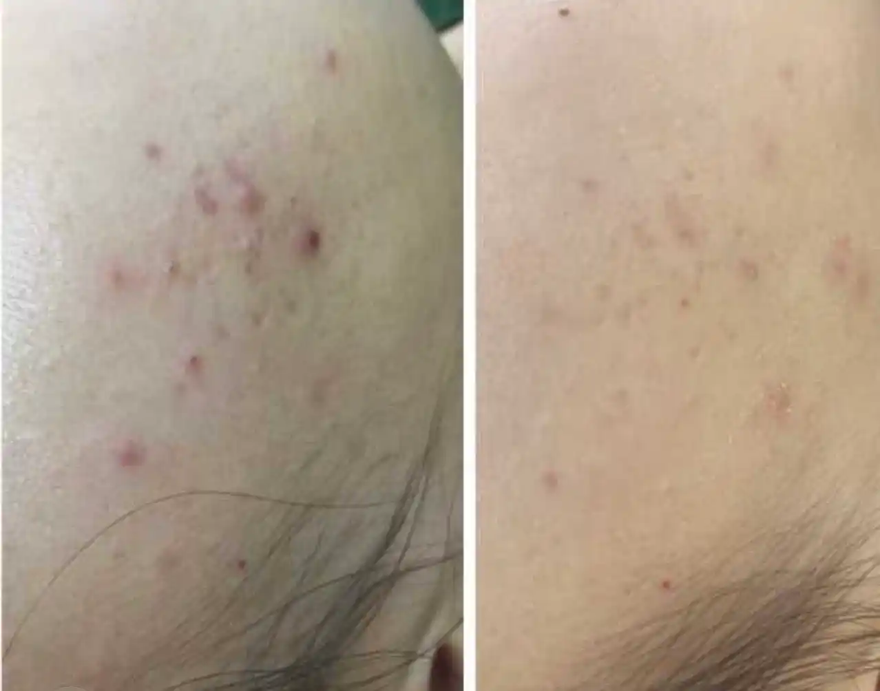 Dr.Althea тонер-пэды 2% Salicylic Acid Pad с салициловой кислотой для проблемной кожи