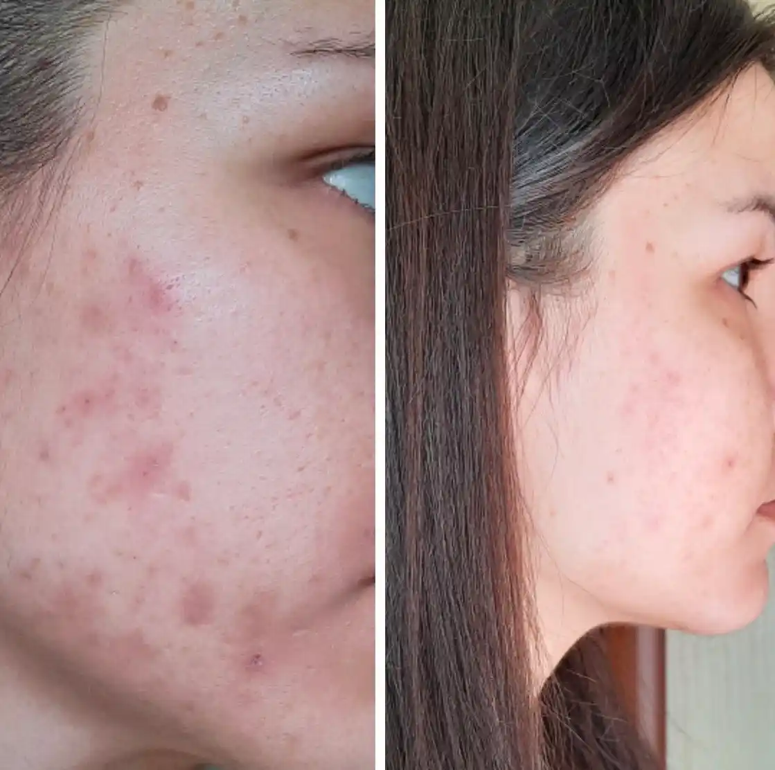 Anua Niacinamide 10% + TXA 4% Serum сыворотка для осветления пигментации следов постакне