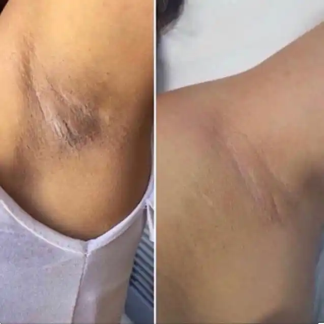 BEAUTÉ Melasma-X 3D oqartiruvchi krem qo‘ltiq, tirsak va bikini sohalari uchun