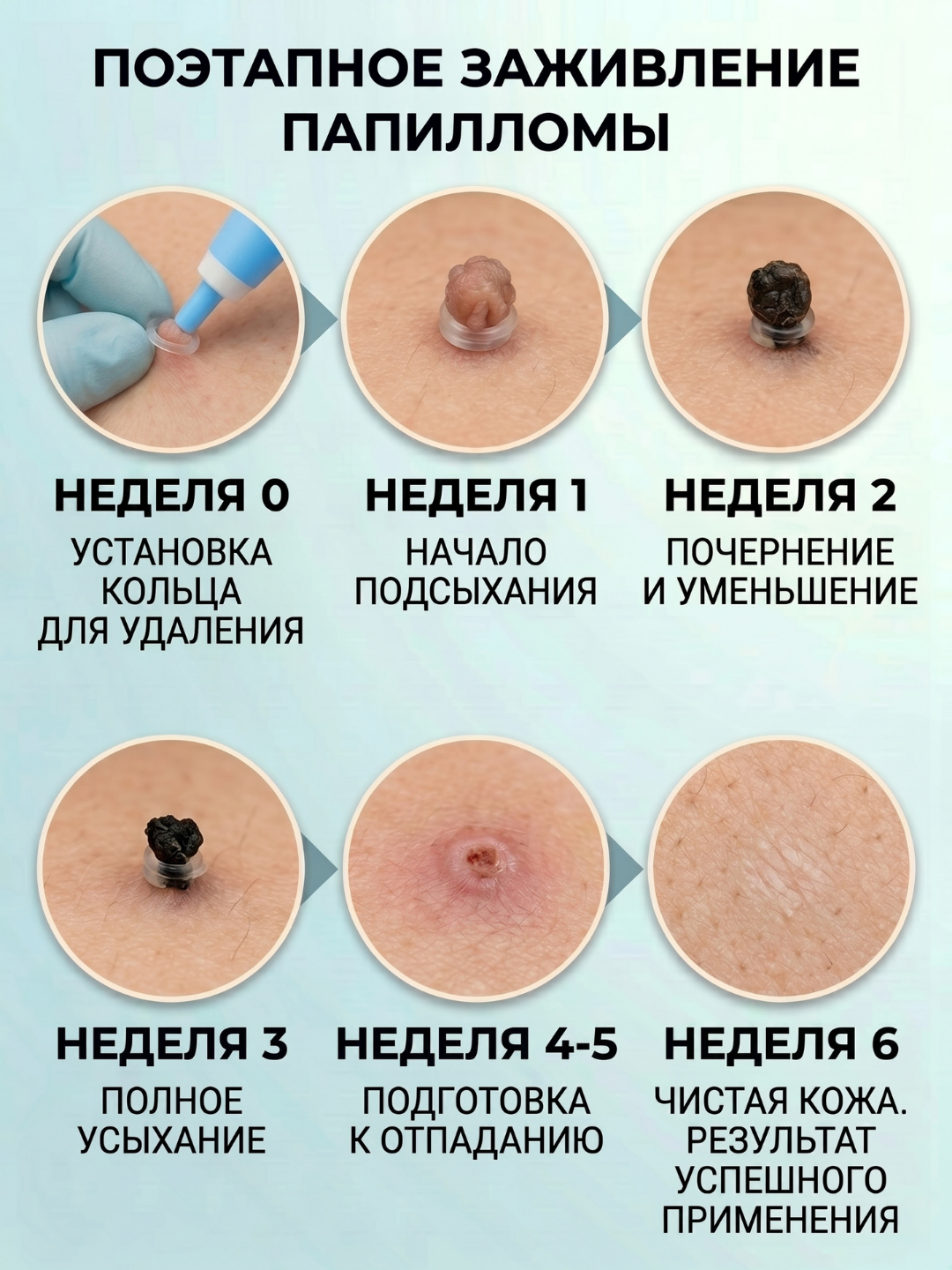 Papilloma va teri o‘simtalarini xavfsiz olib tashlash uchun to‘plam