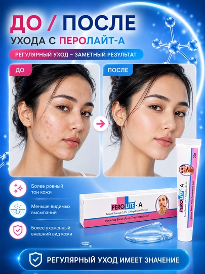 Гель от прыщей ПЕРОЛАЙТ-А, 30 г