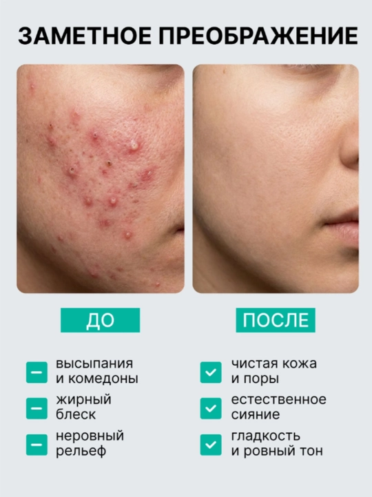 Тоник для лица AYA очищающий от прыщей