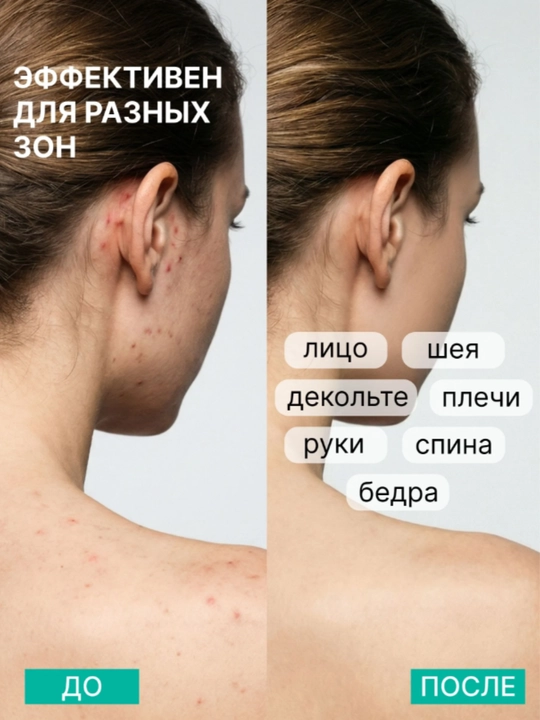 Тоник для лица AYA очищающий от прыщей